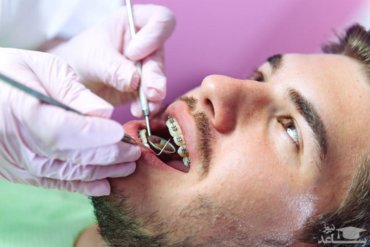 حداکثر سن برای انجام ارتودنسی دندان، چه سنی است؟