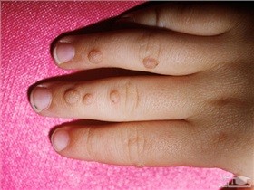 انواع زگیل پوست در کودکان و راه های درمان آن