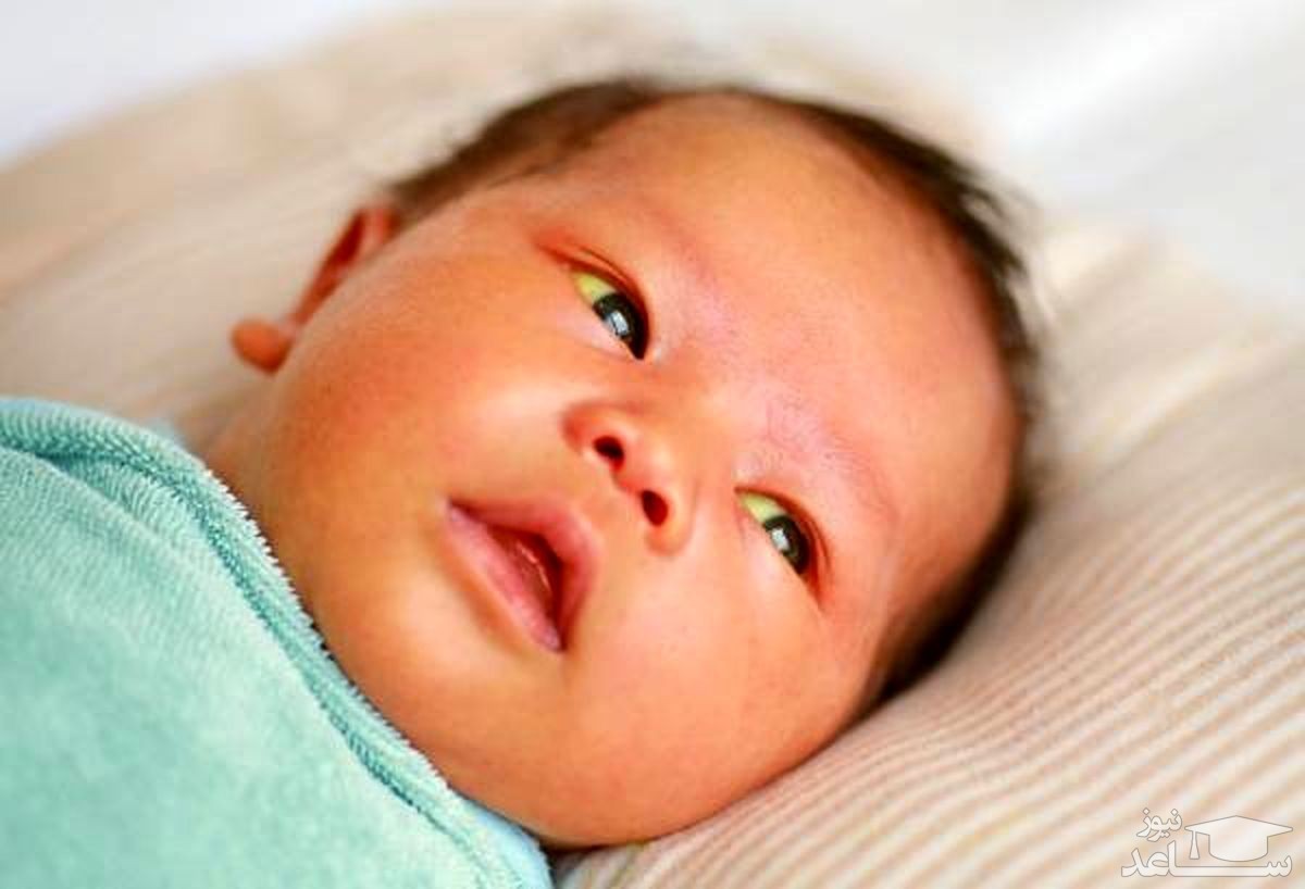 دلایل زرد شدن چشم نوزاد و کودک چیست؟
