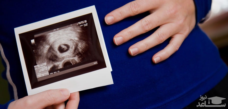 زمان تشکیل ساک بارداری در زنان حامله