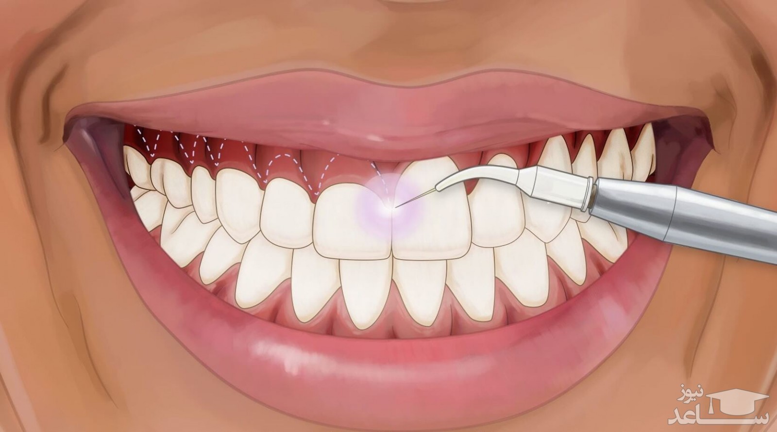 تاثیر روش‌های دندانپزشکی برای زیبایی صورت