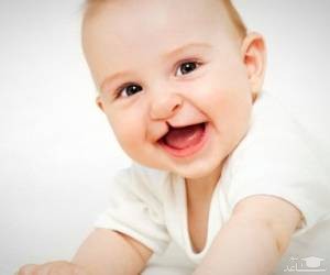 علل شکاف لب در کودکان و راههای درمان آن
