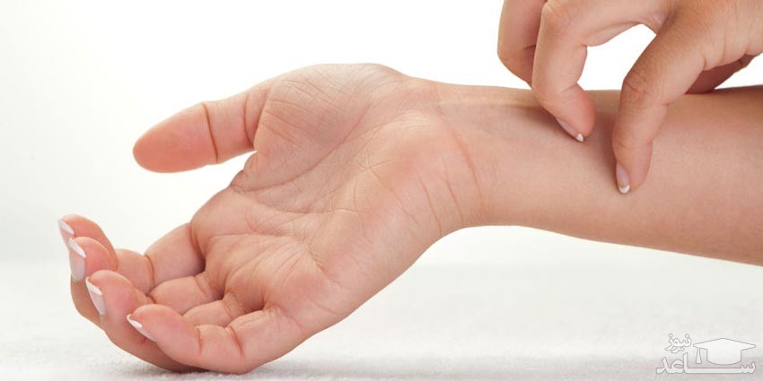 چند روش برای درمان اگزمای پوستی