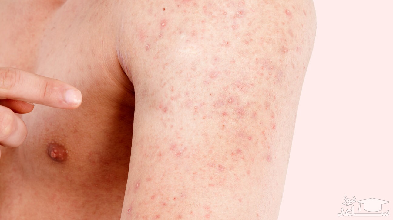 برای خلاص شدن از آکنه های روی بازو چه کار کنیم؟