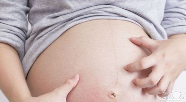 پوستر خارش نواحی شکم در دوران بارداری