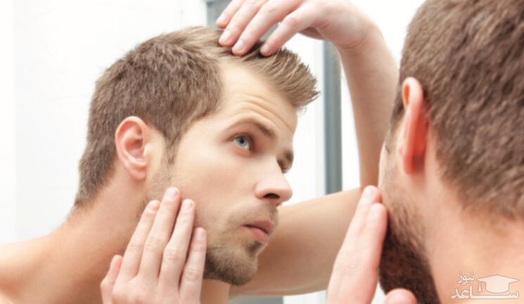 علت ریزش موی پیشانی در مردان