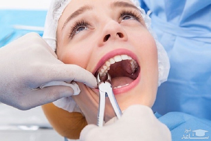 جراحی دندان عقل چگونه انجام می‌شود؟ آیا دردناک است؟