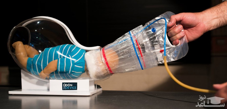 شرایط استفاده از وکیوم هنگام زایمان زنان