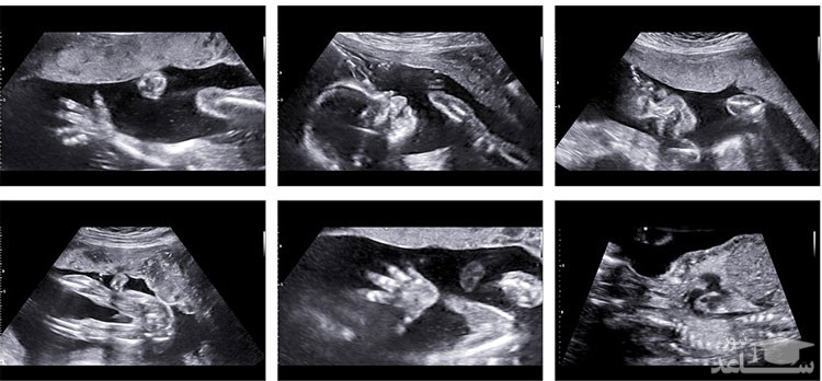 همه چیز درباره سونوگرافی میانه‌ بارداری آنومالی (ناهنجاری)