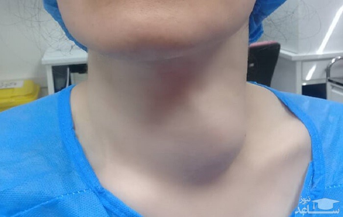 بیماری هوچکین