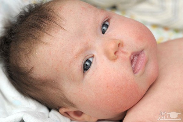علائم اگزما در نوزادان و راههای درمان آن