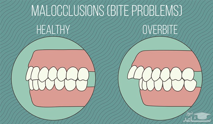 اوربایت دندان باعث چه مشکلاتی میشود؟