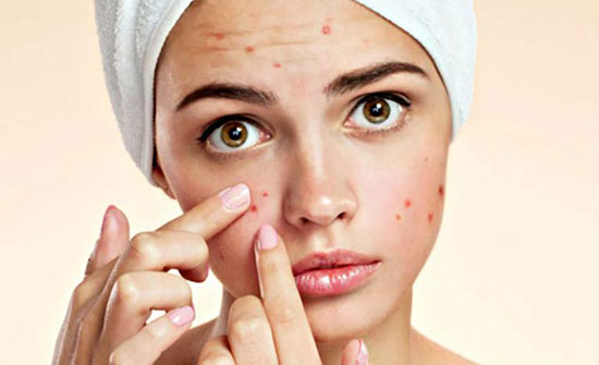 چگونه به وسیله آرایش جوش صورت را بپوشانیم؟