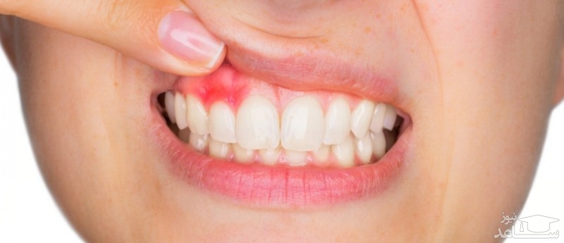 دلایل آبسه دندان در بارداری و روش های درمان