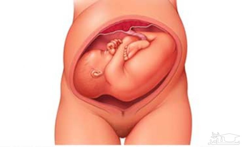 جنین عرضی چیست و چه خطراتی دارد؟