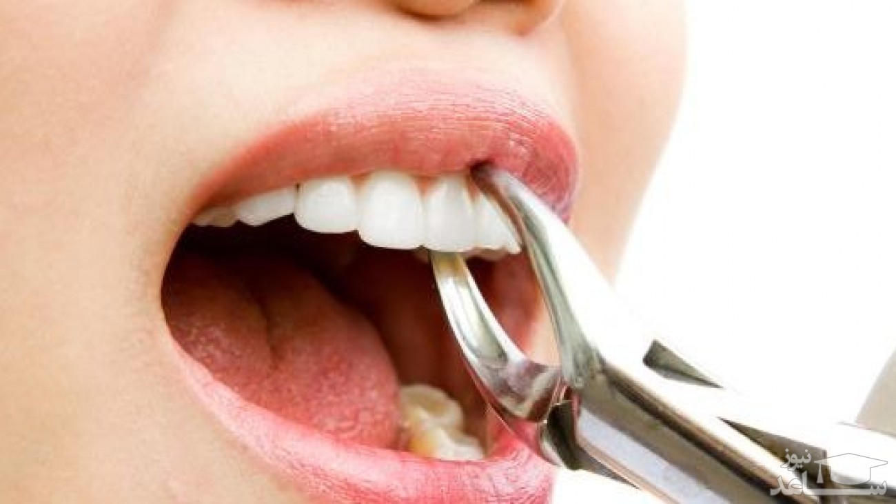 اگر دندان اضافی دارید بخوانید!