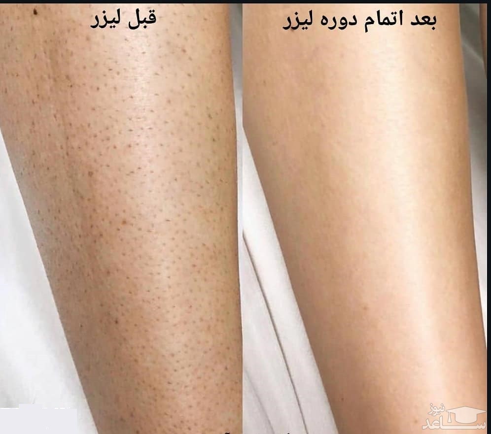 تاثیر لیزر بر پوست