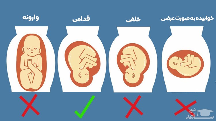 وضعیت قرارگیری جنین در رحم