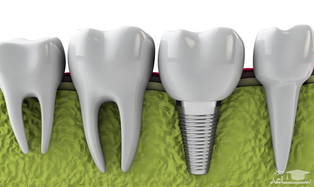 معایب ایمپلنت دندان چیست؟