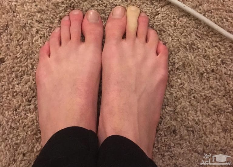 انگشت پای رنگ پریده