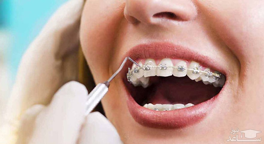 درمان فاصله بین دندان‌ها چگونه امکان پذیر است؟