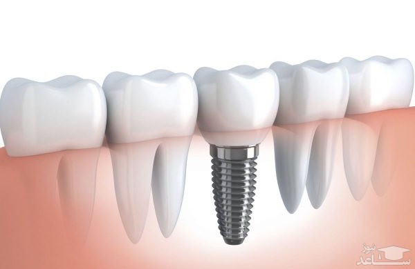 عوارض ایمپلنت برای لثه چیست؟