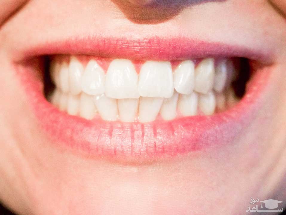 کاشت دندان به روش پل ثابت چگونه است؟
