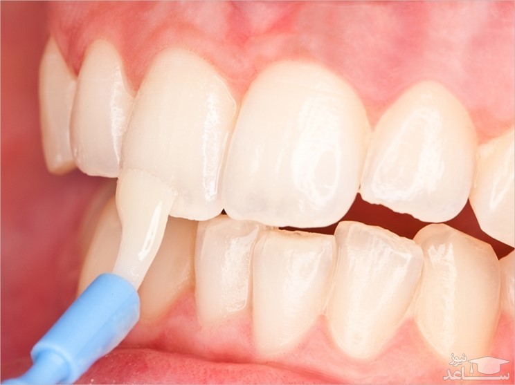 هدف و کاربرد لمینت های سرامیکی دندان چیست؟