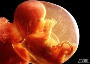 خطرات کم بودن مایع آمنیوتیک در بارداری