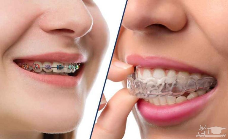 نحوه ی انتخاب یکی از دستگاه های ارتودنسی که مناسب دندان های شماست!