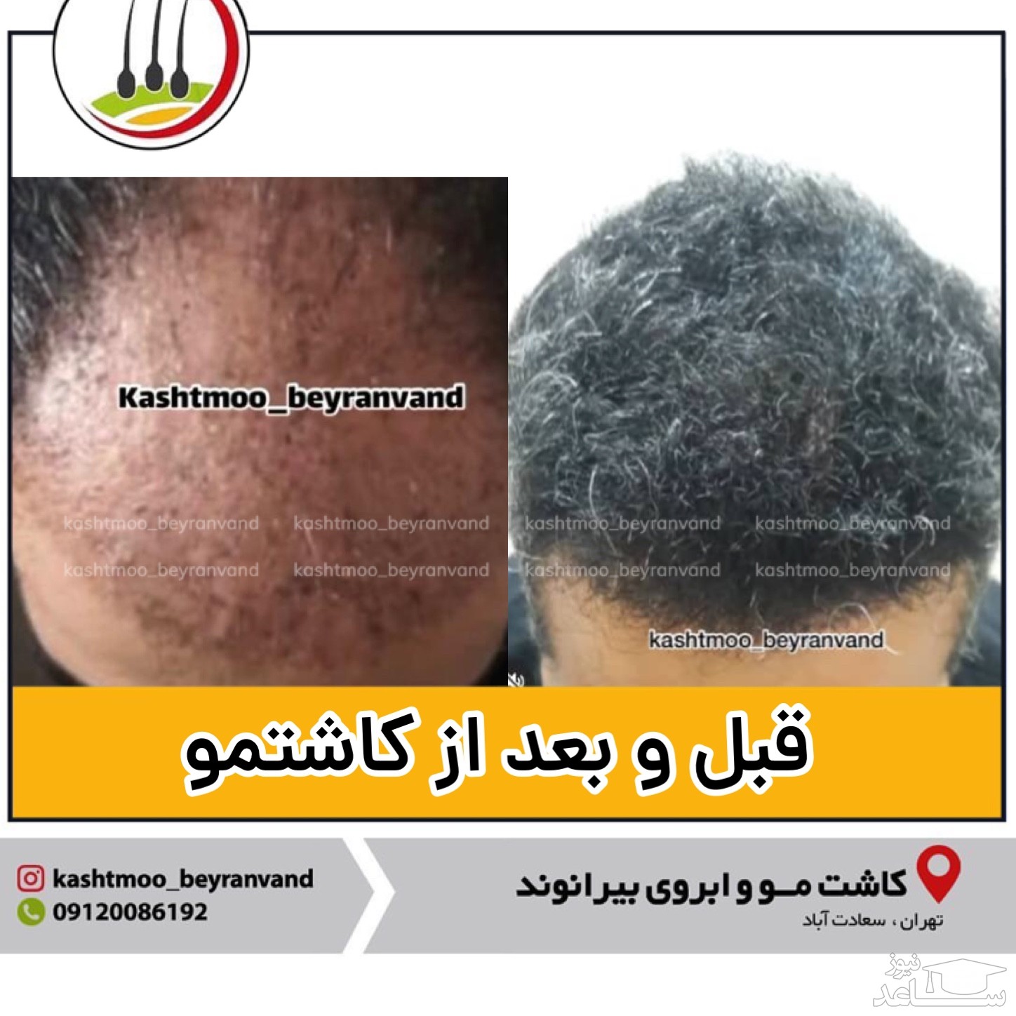 بعد از کاشت مو چه کار کنیم؟