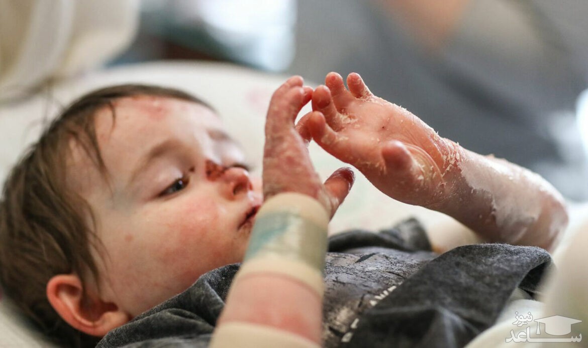 داروهای بیماران پروانه‌ای رایگان شد