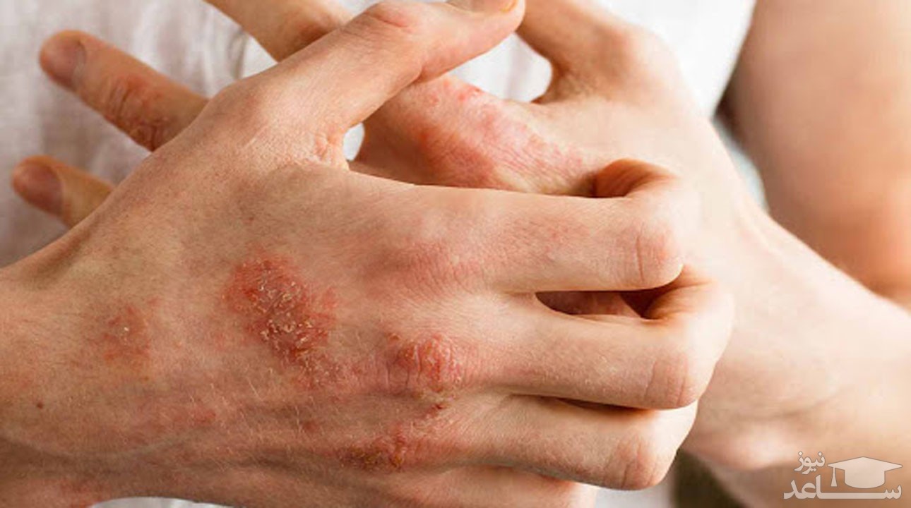 10 بیماری که خود را با خارش پوست نشان می دهند
