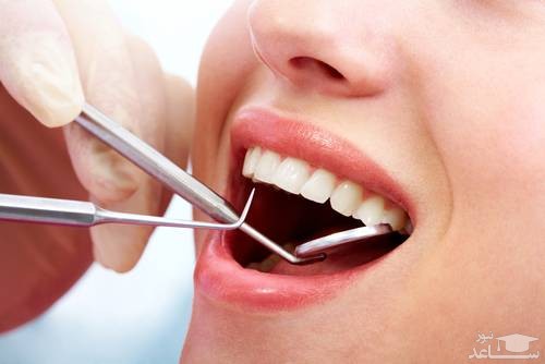 مراحل پرکردن دندان چگونه است؟