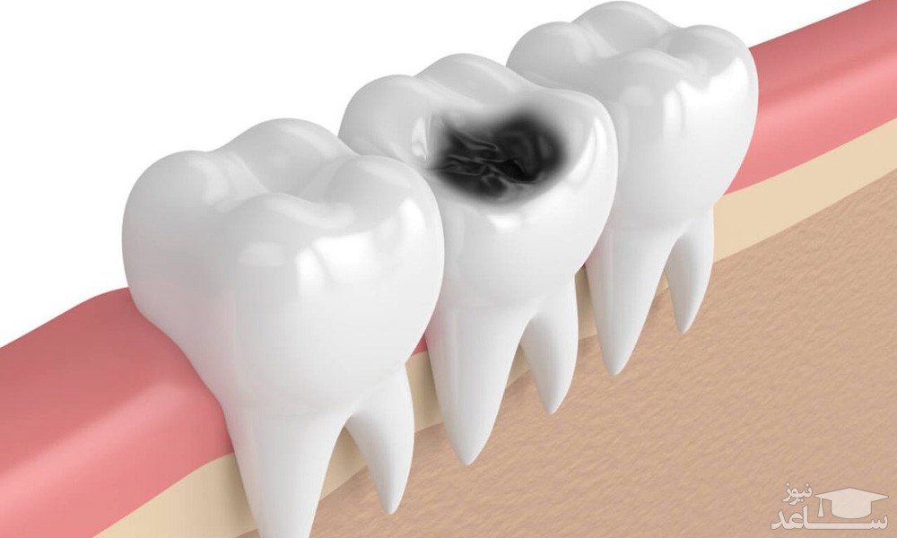 التهابات و درد دندان ناشی از چیست؟