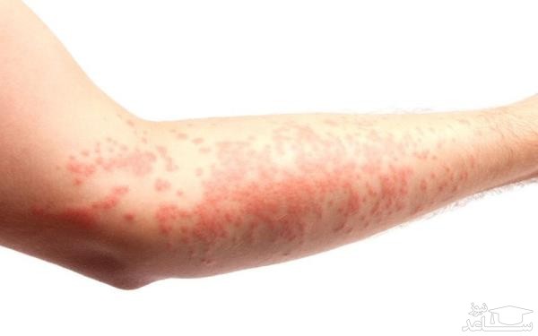 روش های درمان گیاهی پسوریازیس