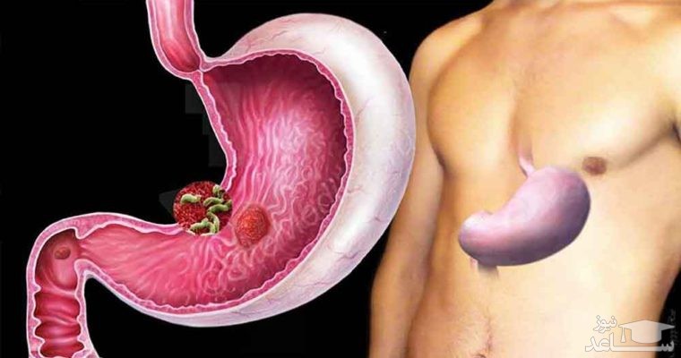 علل هلیکو باکتر پیلوری در معده و راههای درمان آن