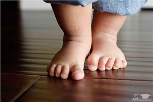 بد شکل شدن فرم پا در اثر پوشک کردن کودک