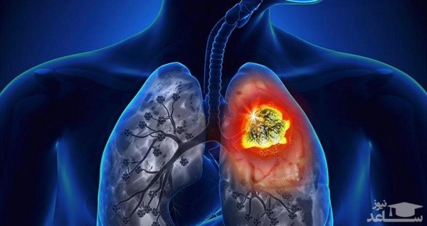 سرطان ریه
