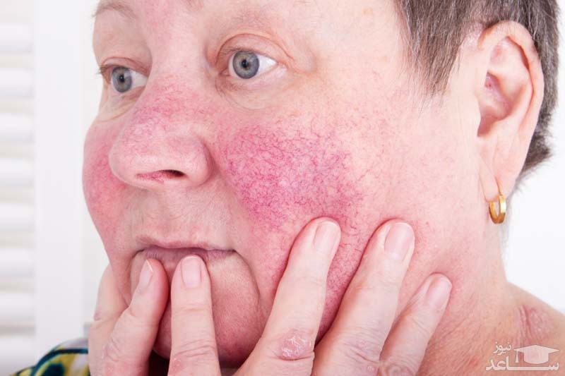 علل ایجاد رگ های قرمز روی صورت و راه های درمان آن