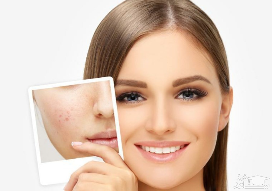 روش‌های سفید کردن پوست صورت با لیموترش و عسل