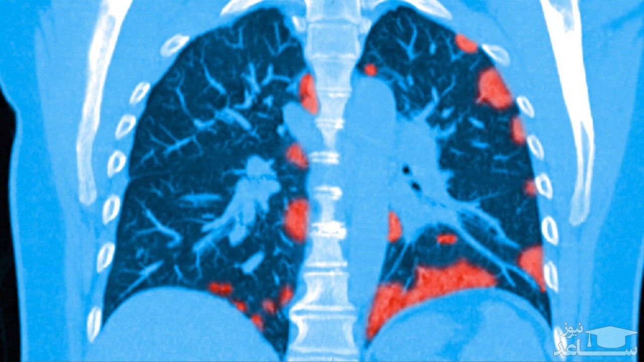 احتمال ماندگاری مشکلات ریوی در بیماران کرونایی