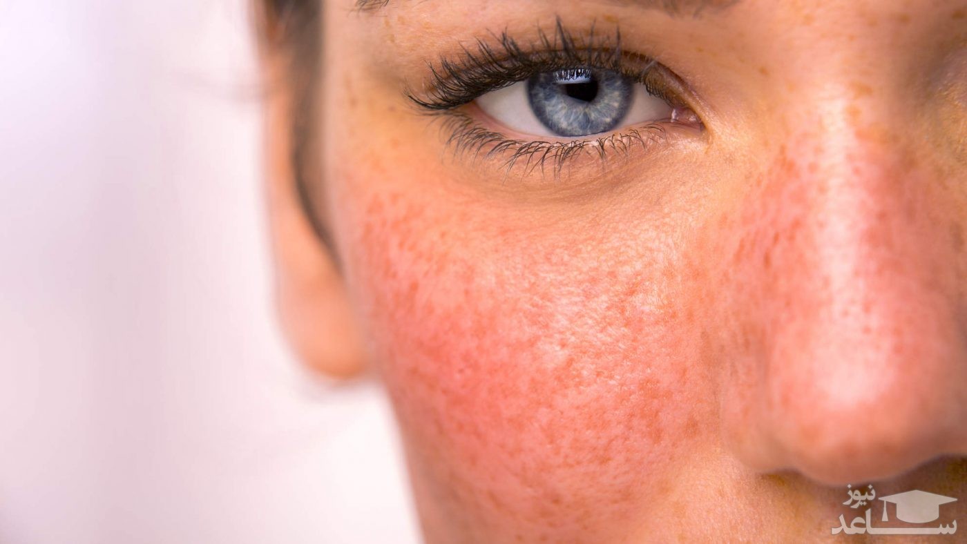۱۲ عاملی که سبب قرمزی پوست می‌شود