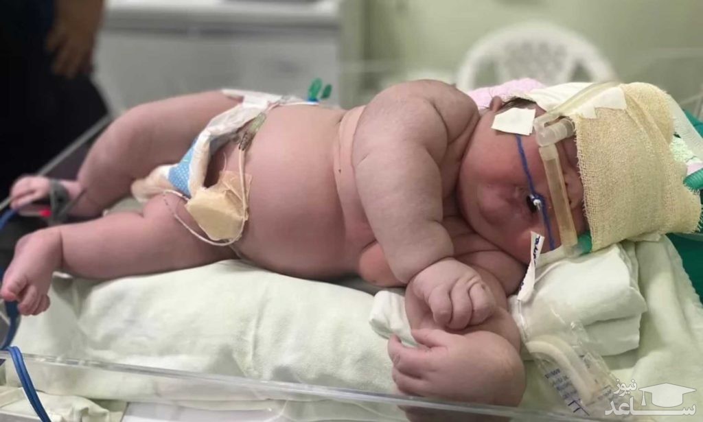 تولد نوزاد ۷ کیلویی با ۶۰ سانتیمتر قد از طریق سزارین +عکس