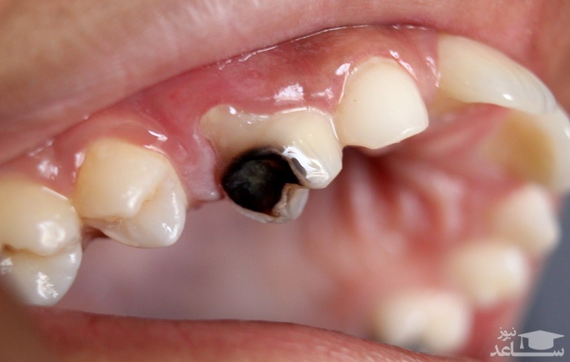 آیا کامپوزیت دندان ها را خراب می کند؟