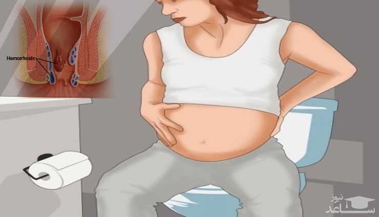 روش های درمان بواسیر یا هموروئید در بارداری