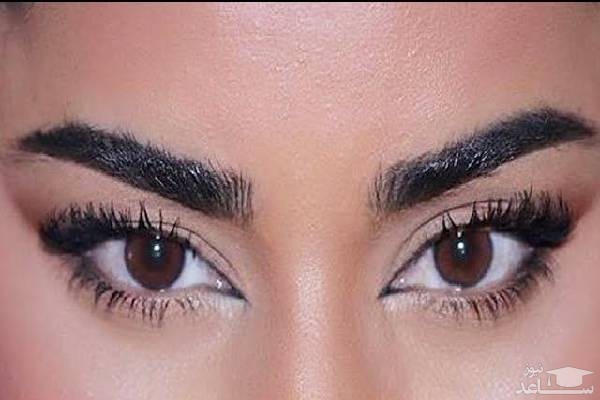 عمل کانتوپلاستی چشم