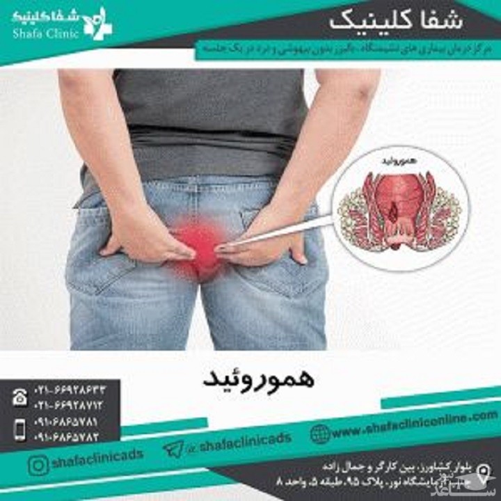 درمان هموروئید بدون درد