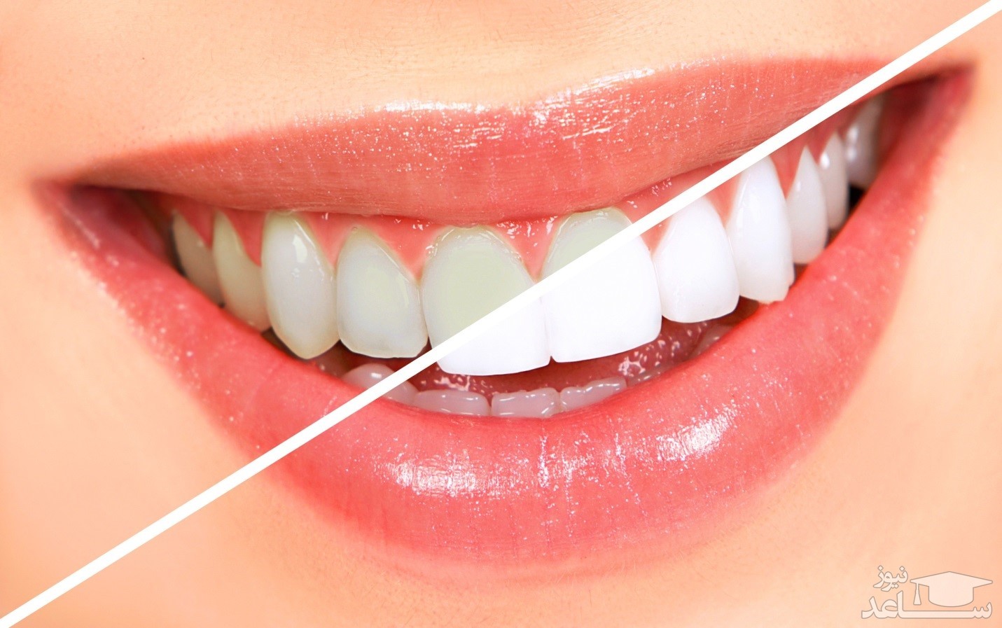 درمان حساسیت بعد از بلیچینگ دندان با چند روش ساده