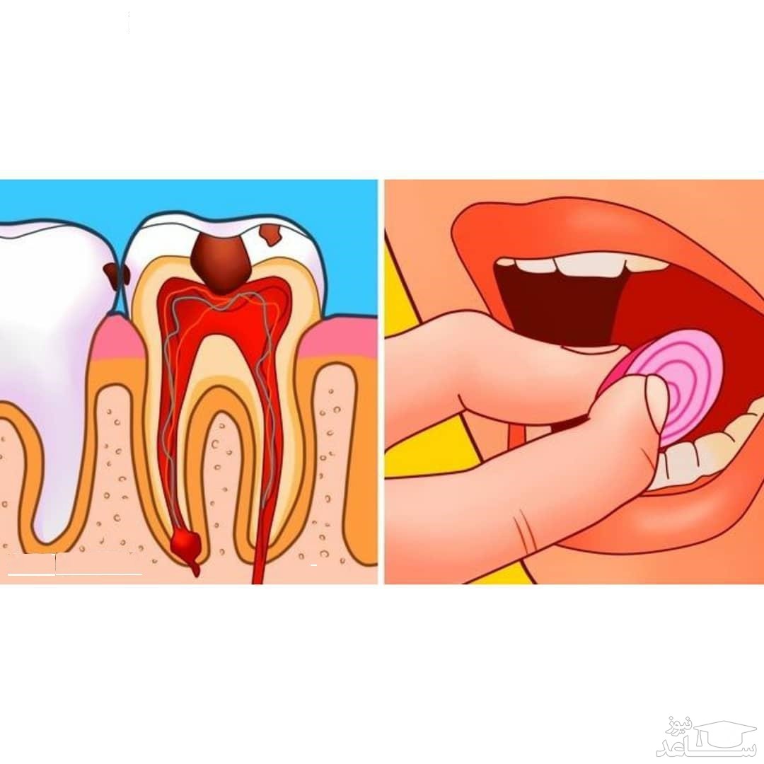 پیاز برای دندان درد